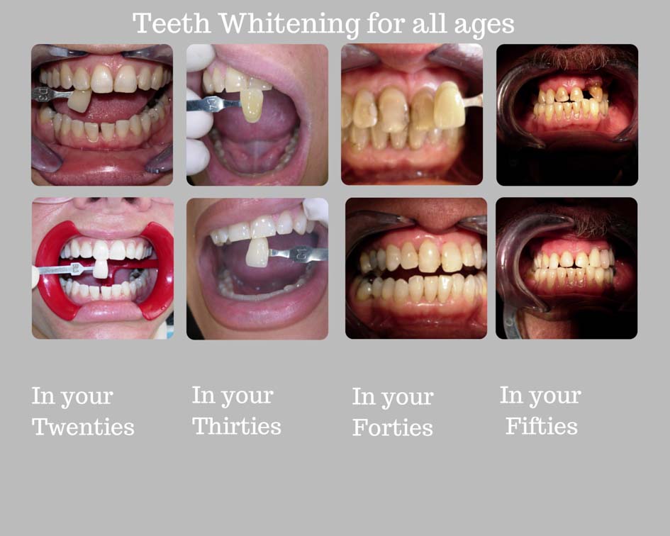 Teeth_Whitening_Newbury_Berkshire