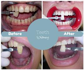 Teeth Whitening Newbury