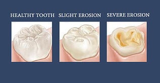 tooth_erosion
