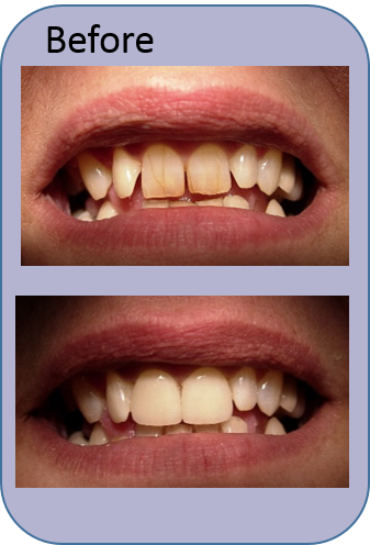 Before_and_After_Dental Veneers Newbury