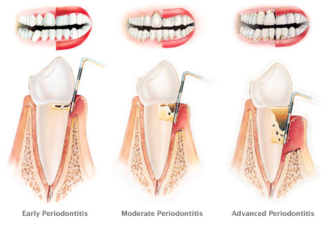 periodontital-disease